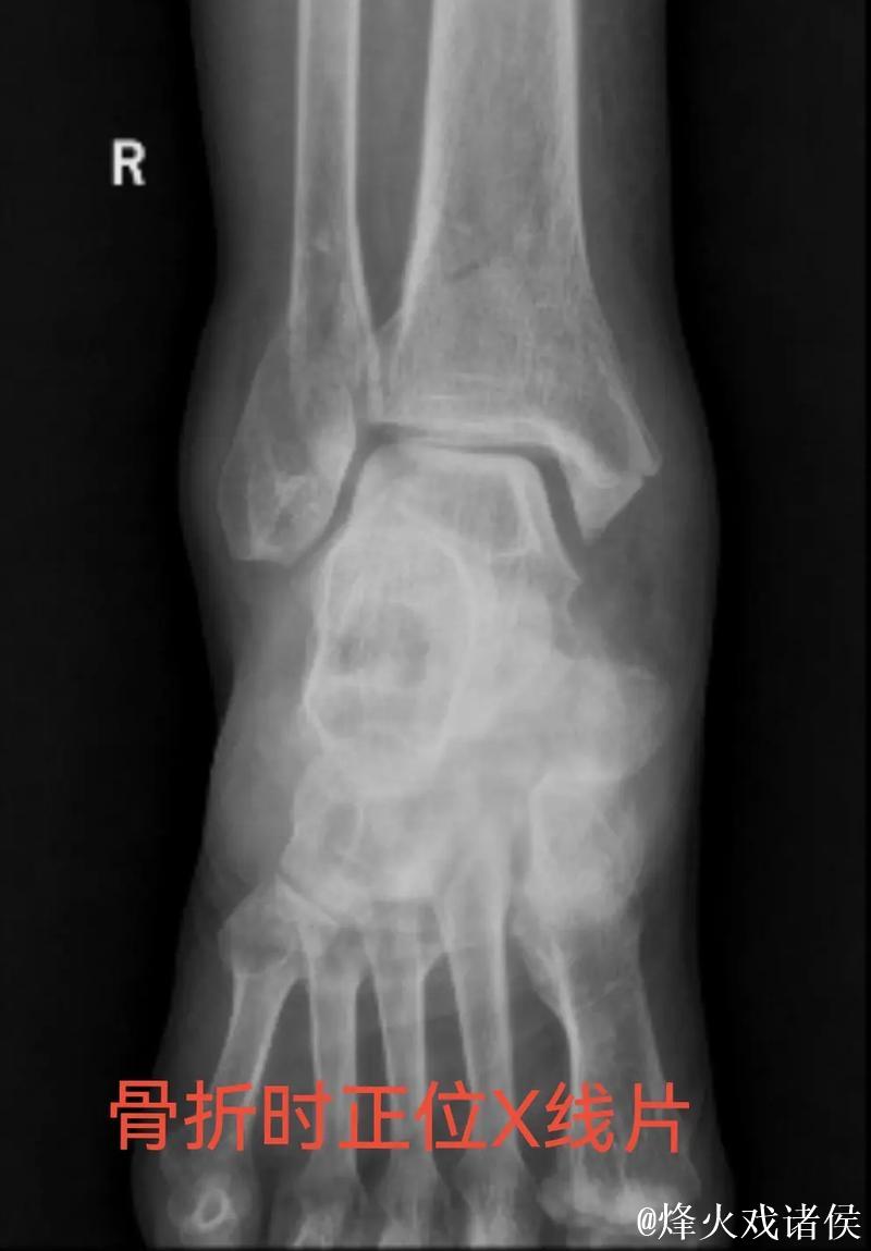 林孝天重伤!右踝三角韧带断裂 右侧腓骨骨折 林孝天重伤!右踝三角韧带断裂 右侧腓骨骨折